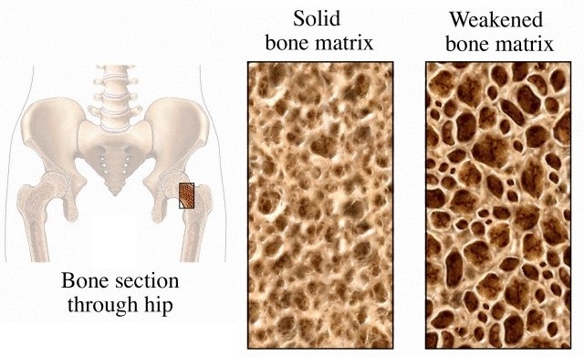 01 Jun 2007 --- Biomedical illustration depicting osteoporosis using three illustrations. The first graphic shows an orientation to the bone section though the hip from a coronal (cut-way) view. The second image pictures solid bone matrix, and the third shows weakened bo --- Image by © Nucleus Medical Art/Visuals Unlimited/Corbis